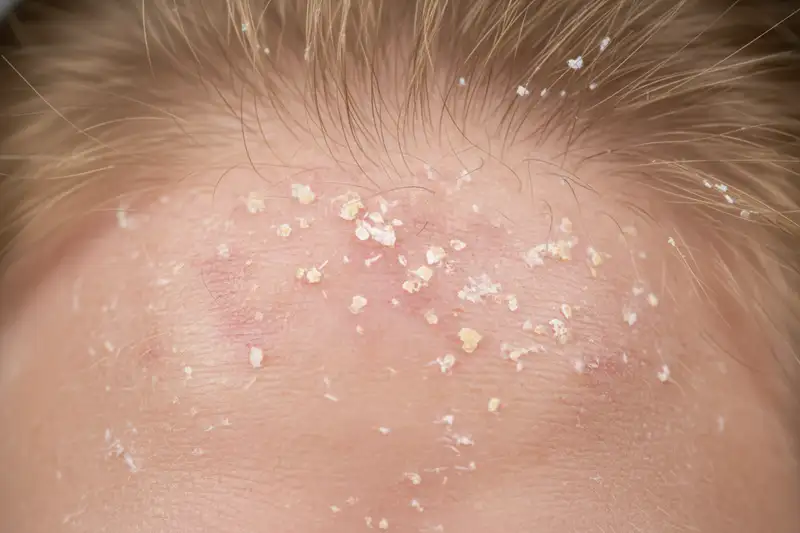 Typische Rötungen und Schuppung bei seborrhoischem Ekzem der Kopfhaut