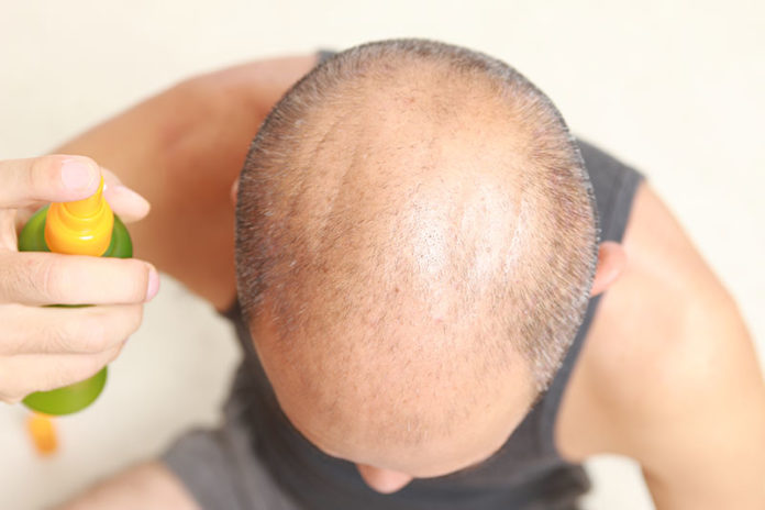 Ein Mann mit Haarausfall (Deeblue/Depositphotos)
