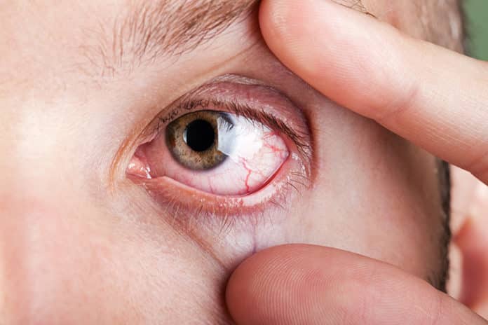 trockenes-auge Ein trockenes und gerötetes Auge